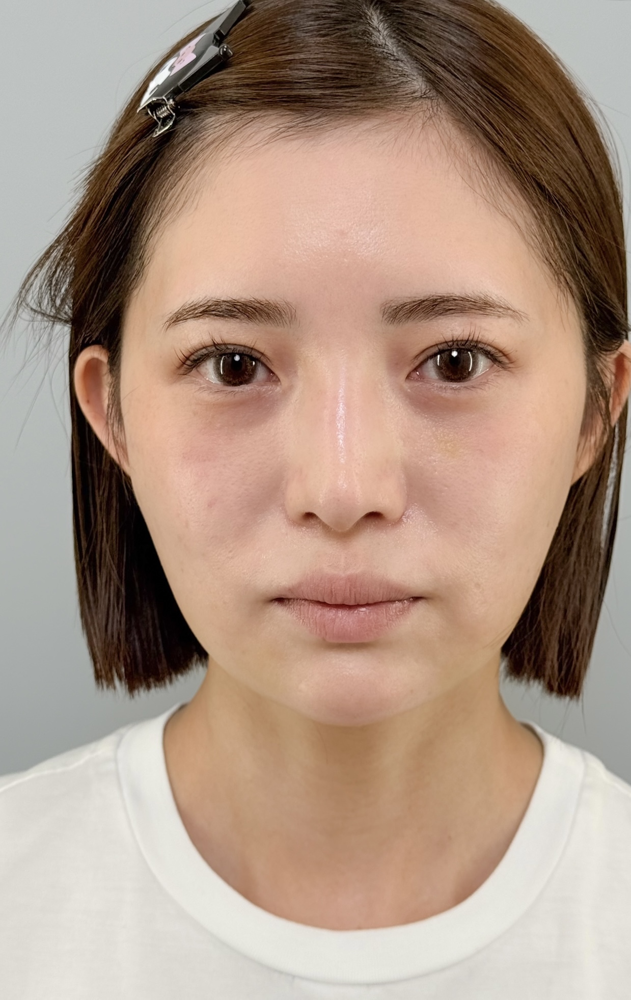 治療後（メイクなし）1